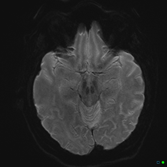 File:Brain death on MRI and CT angiography (Radiopaedia 42560-45689 Axial DWI 10).jpg
