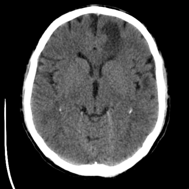 Brain metastases from lung cancer (Radiopaedia 24480-24781 Axial non-contrast 21).jpg