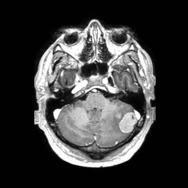 Brain metastases from lung cancer (Radiopaedia 83839-99028 Axial T1 C+ 11).jpg