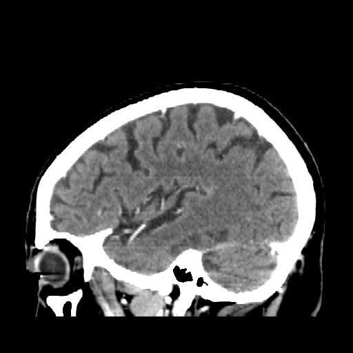 Brain metastasis (Radiopaedia 42617-45760 D 10).jpg