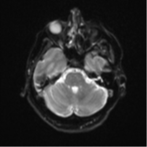Brain metastasis (sarcoma) (Radiopaedia 47576-52209 Axial DWI 8).png