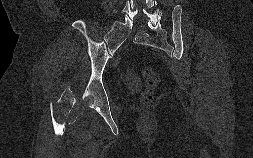 Breast carcinoma with pathological hip fracture (Radiopaedia 60314-67993 Coronal bone window 80).jpg