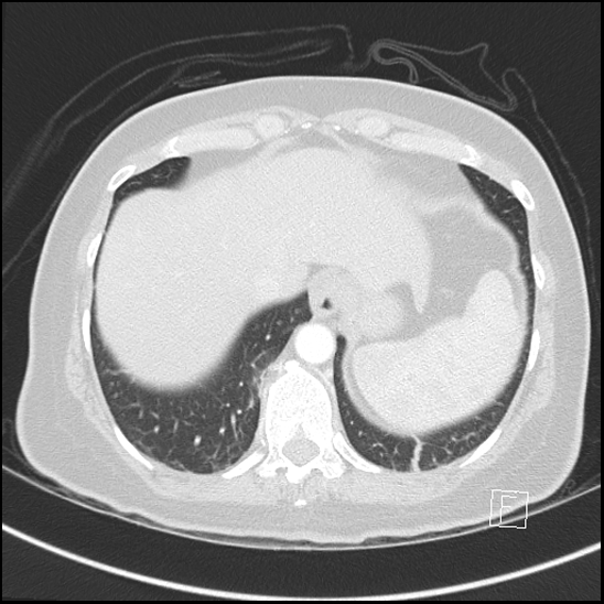 File:Breast metastases from renal cell cancer (Radiopaedia 79220-92225 Axial lung window 72).jpg
