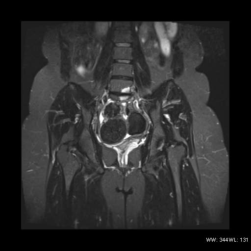 File:Broad ligament fibroid (Radiopaedia 49135-54241 Coronal STIR 16).jpg