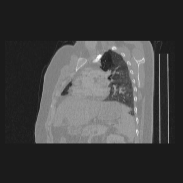 Bronchial atresia (Radiopaedia 60685-68439 Sagittal lung window 57).jpg