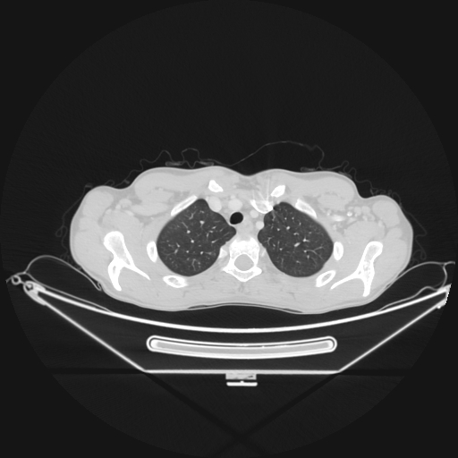 Bronchial carcinoid tumor (Radiopaedia 57187-64090 Axial lung window 10).jpg