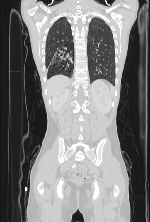 Bronchial carcinoid tumor (Radiopaedia 57187-64090 Coronal lung window 88).jpg