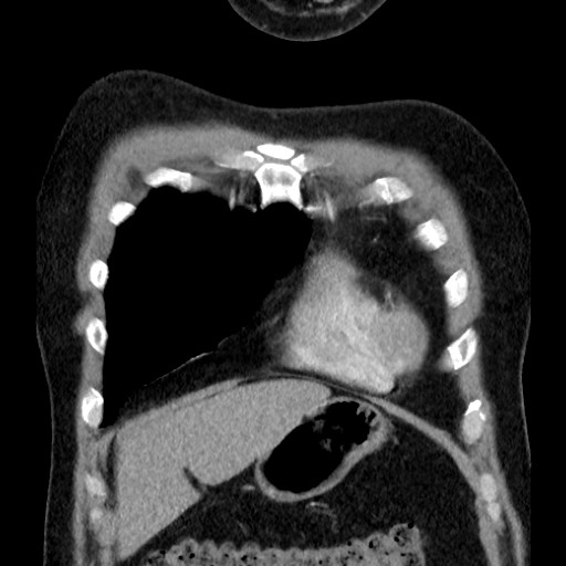 Bronchial carcinoid tumor (Radiopaedia 67377-76764 C 20).jpg