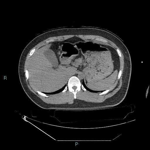 Bronchial carcinoid tumor (Radiopaedia 78272-90870 Axial non-contrast 104).jpg