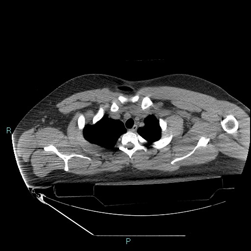 Bronchial carcinoid tumor (Radiopaedia 78272-90870 Axial non-contrast 16).jpg