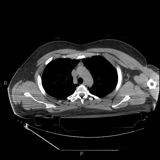 Bronchial carcinoid tumor (Radiopaedia 78272-90870 Axial non-contrast 30).jpg