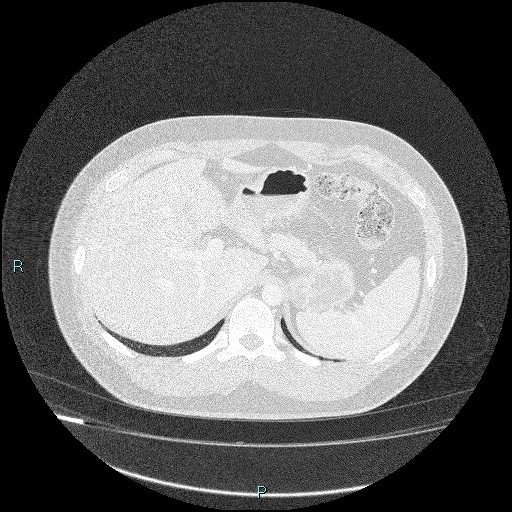 Bronchial carcinoid tumor (Radiopaedia 78272-90875 Axial lung window 53).jpg