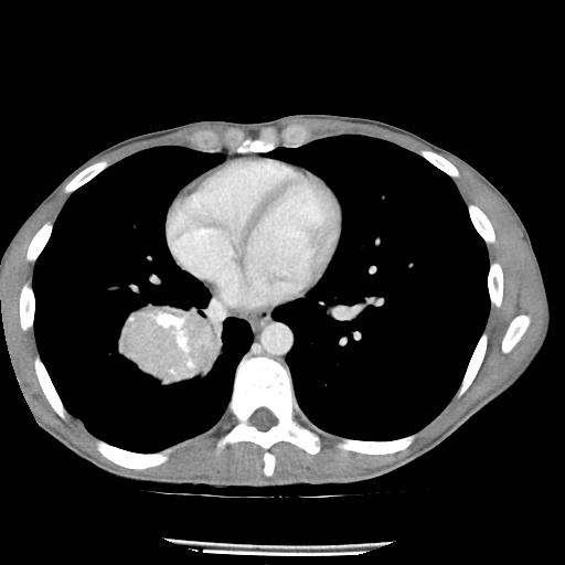 Bronchial carcinoid tumor causing right lower lobe collapse (Radiopaedia 83495-98594 A 33).jpg