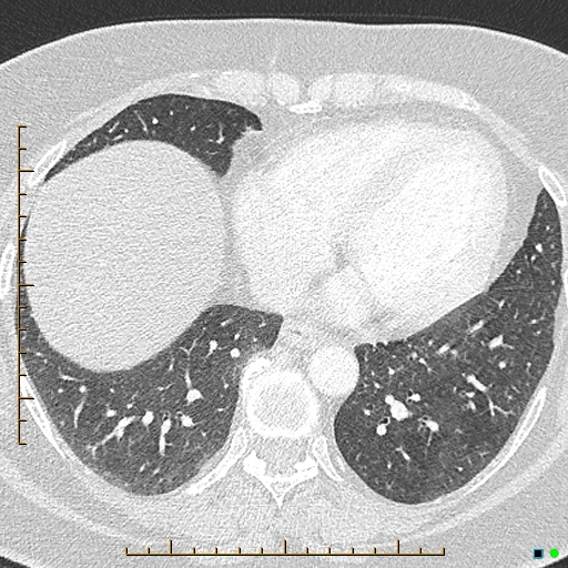 Bronchial diverticula (Radiopaedia 79512-92676 Axial lung window 148).jpg