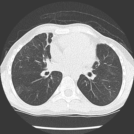 File:Bronchiolotis obliterans (Radiopaedia 73769-84575 Axial lung window 26).jpg