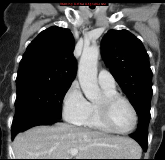 Bronchoalveolar carcinoma (BAC) (Radiopaedia 13436-13392 E 19).jpg