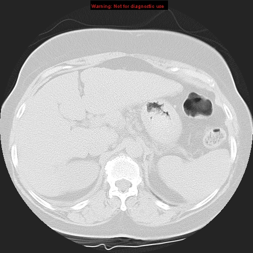Bronchoalveolar carcinoma (Radiopaedia 13224-13233 Axial lung window 49).jpg