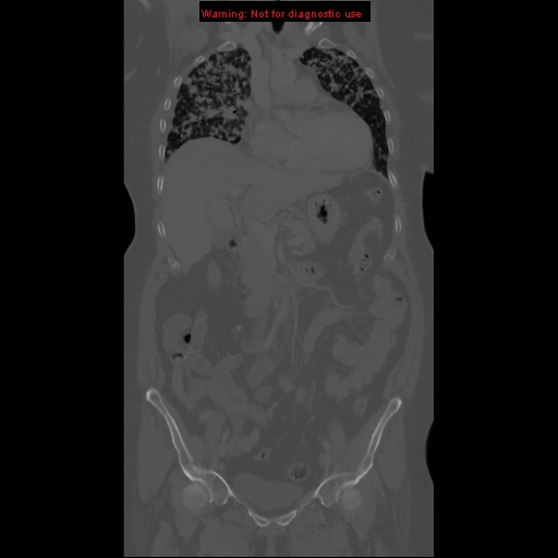 File:Bronchoalveolar carcinoma (Radiopaedia 13224-13233 Coronal non-contrast 1).jpg