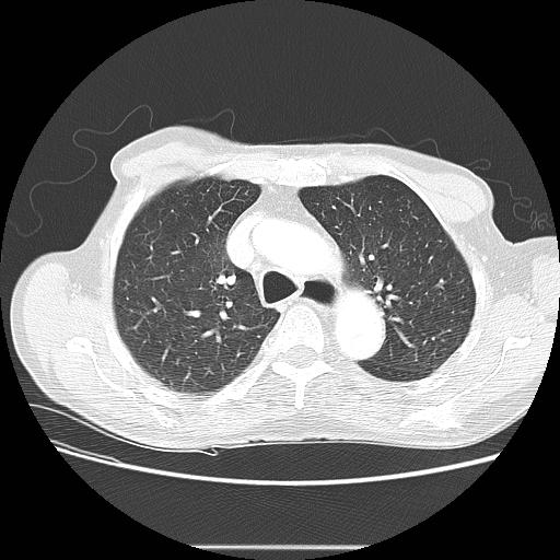 Bronchocele (Radiopaedia 17097-16795 Axial lung window 36).jpg