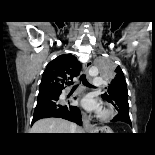 Bronchogenic carcinoma (Radiopaedia 73497-84262 C 73).jpg