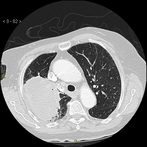 File:Bronchogenic carcinoma as an incidental finding (Radiopaedia 16453-16130 Axial lung window 82).jpg