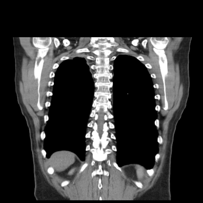 Bronchogenic carcinoma with upper lobe collapse (Radiopaedia 29297-29726 D 44).jpg
