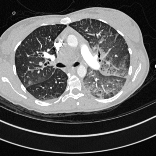 Bronchogenic cyst (Radiopaedia 77801-90071 Axial lung window 22).jpg