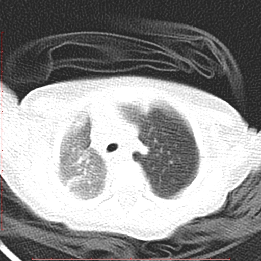Bronchogenic cyst (Radiopaedia 78599-91409 Axial lung window 38).jpg