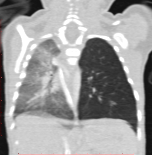 Bronchogenic cyst (Radiopaedia 78599-91409 Coronal lung window 151).jpg