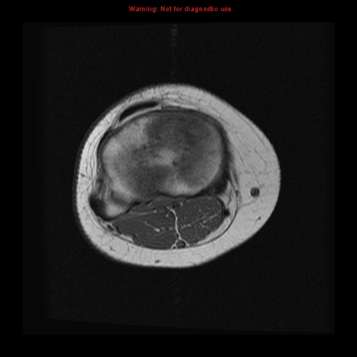 File:Brown tumor (Radiopaedia 12318-12597 Axial T1 11).jpg