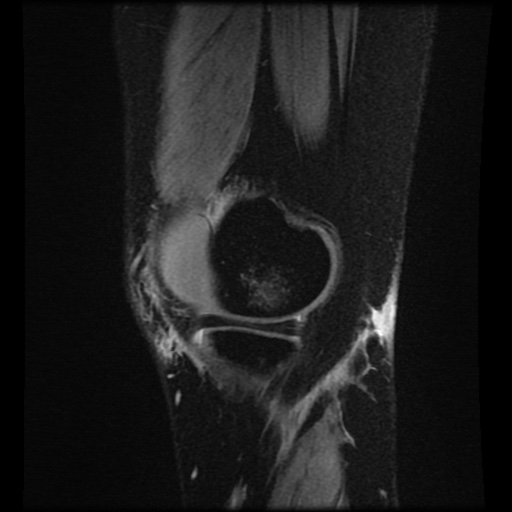 Bucket handle meniscus tear (Radiopaedia 56916-63751 H 72).jpg