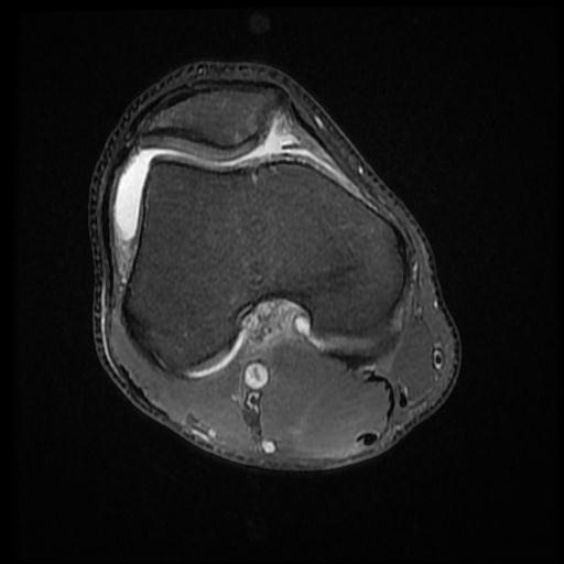 File:Bucket handle tear - medial meniscus (Radiopaedia 69245-79026 Axial PD fat sat 6).jpg