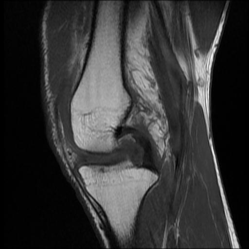 File:Bucket handle tear - medial meniscus (Radiopaedia 69245-79026 Sagittal T1 11).jpg