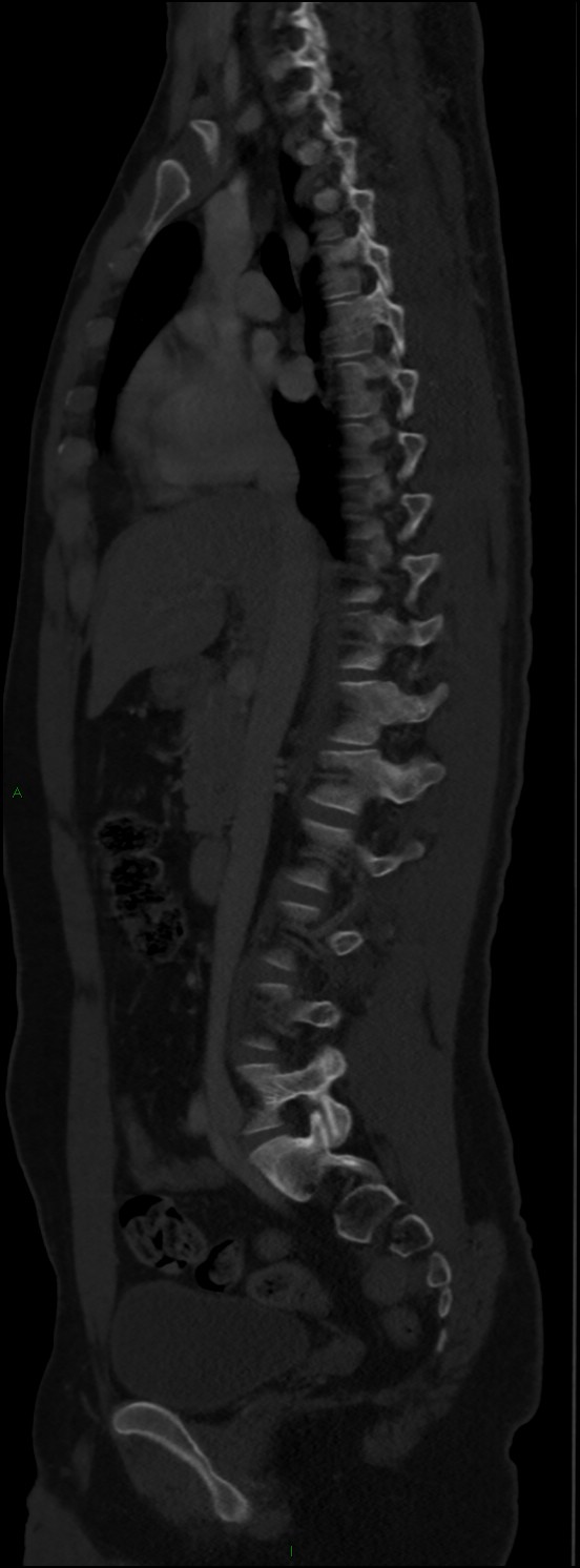 Burst fracture (Radiopaedia 83168-97542 Sagittal bone window 61).jpg