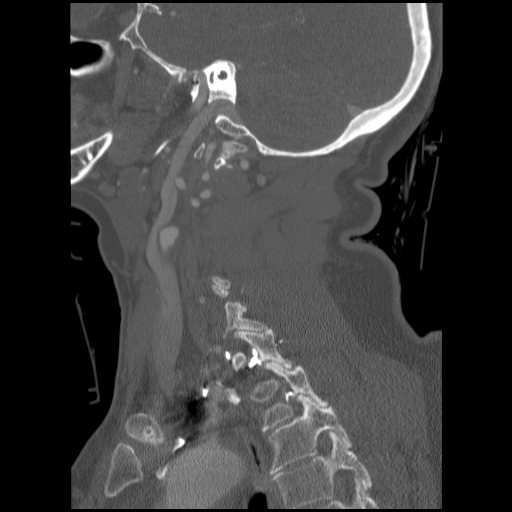 File:C1 anterior arch (plough) fracture - type 1 (Radiopaedia 76181-87720 Sagittal bone window 37).jpg