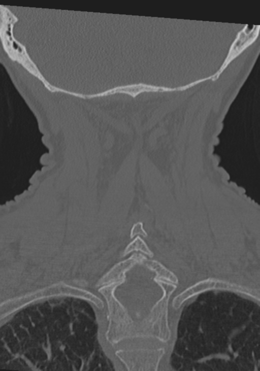 C2 fracture with vertebral artery dissection (Radiopaedia 37378-39199 Coronal bone window 41).png