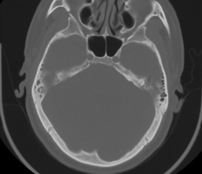 C7 laminar fracture and Klippel-Feil syndrome (Radiopaedia 86710-102850 Axial bone window 8).jpg