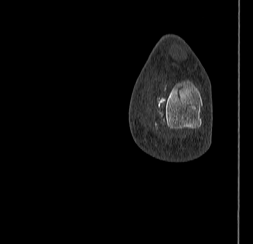 Calcaneal fracture - Sanders type 4 (Radiopaedia 90179-107370 Coronal bone window 84).jpg