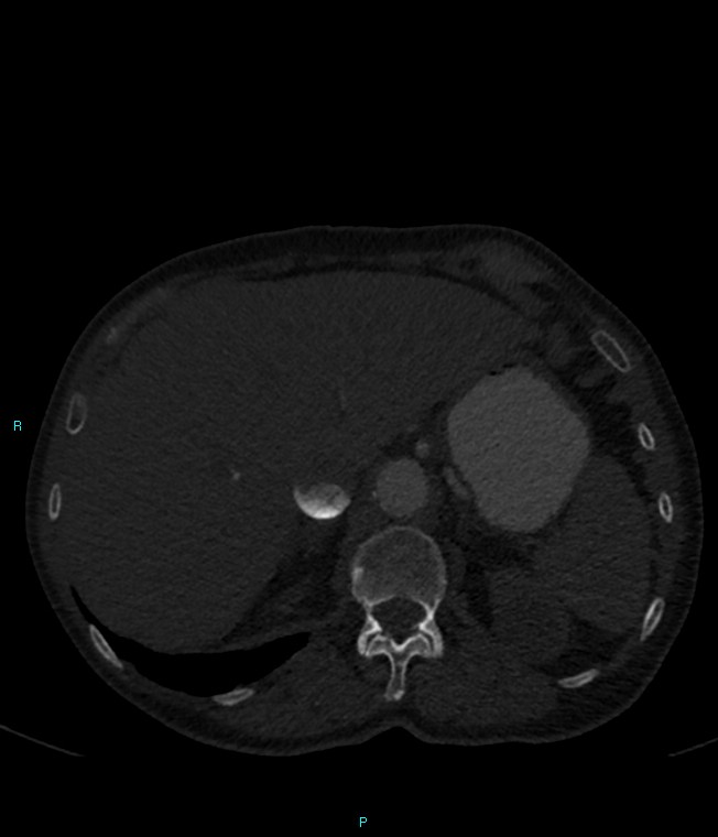 Calcified cerebral emboli from left ventricular thrombus (Radiopaedia 84420-99760 Axial bone window 81).jpg