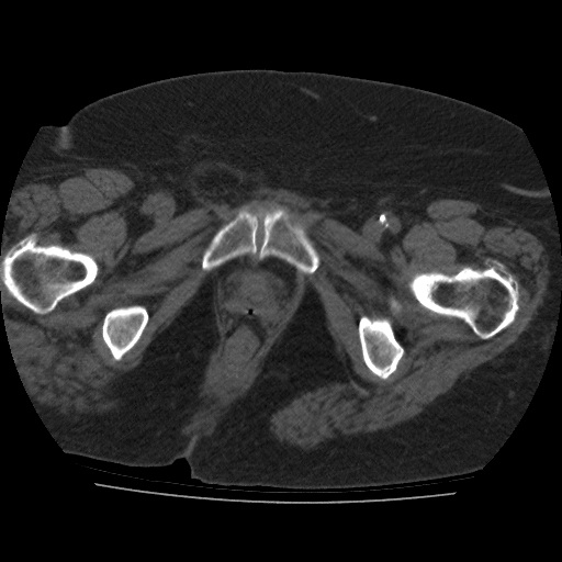 File:Calcified fibroids (Radiopaedia 16853-16579 non-contrast 18).jpg