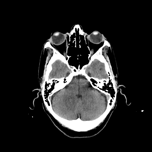 File:Calcified meningioma - cervical canal (Radiopaedia 70136-80171 Axial non-contrast 8).jpg