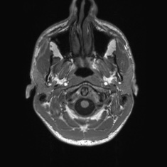 Callosal dysgenesis with interhemispheric cyst (Radiopaedia 53355-59335 Axial T1 3).jpg