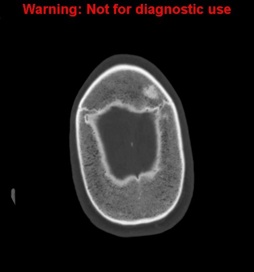 Calvarial thickening from chronic shunting (Radiopaedia 60079-67637 Axial bone window 170).jpg