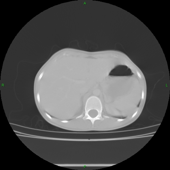 File:Cannon ball metastases - synovial sarcoma (Radiopaedia 26135-26271 Axial lung window 36).jpg