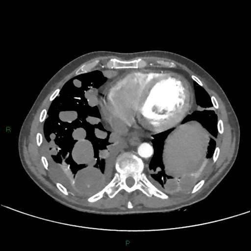 Cannonball metastases (Radiopaedia 82110-96150 Axial C+ CTPA 233).jpg
