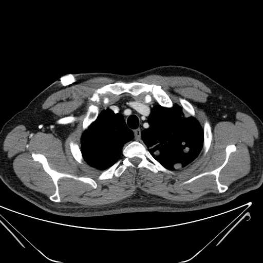 File:Cannonball pulmonary metastases (Radiopaedia 67684-77101 D 48).jpg