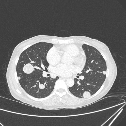 File:Canonball lung metastasis (Radiopaedia 77634-89837 Axial lung window 97).jpg