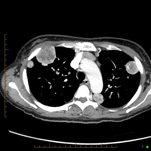 Canonball lung metastasis (Radiopaedia 77634-89837 B 26).jpg