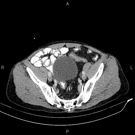 Caput medusae sign - portal hypertension (Radiopaedia 64007-72759 A 81).jpg