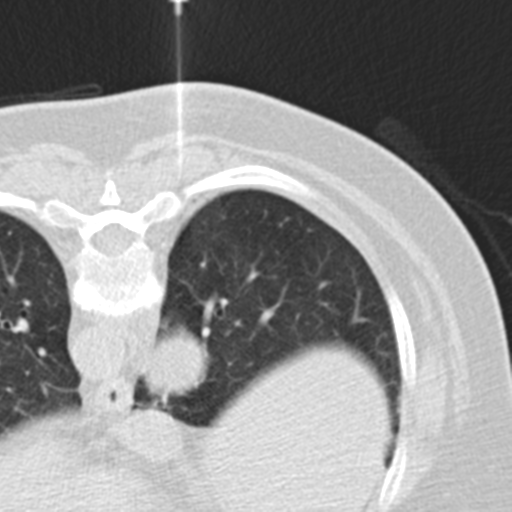 File:Carcinoid tumor - lung (Radiopaedia 44814-48644 Axial lung window 56).png